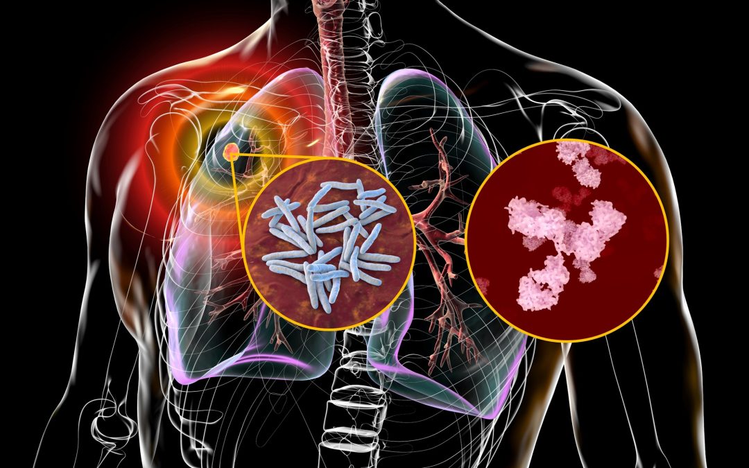 Professor Lobelia Samavati | Paving the Way for Antibody-based Diagnostics for Tuberculosis and Sarcoidosis