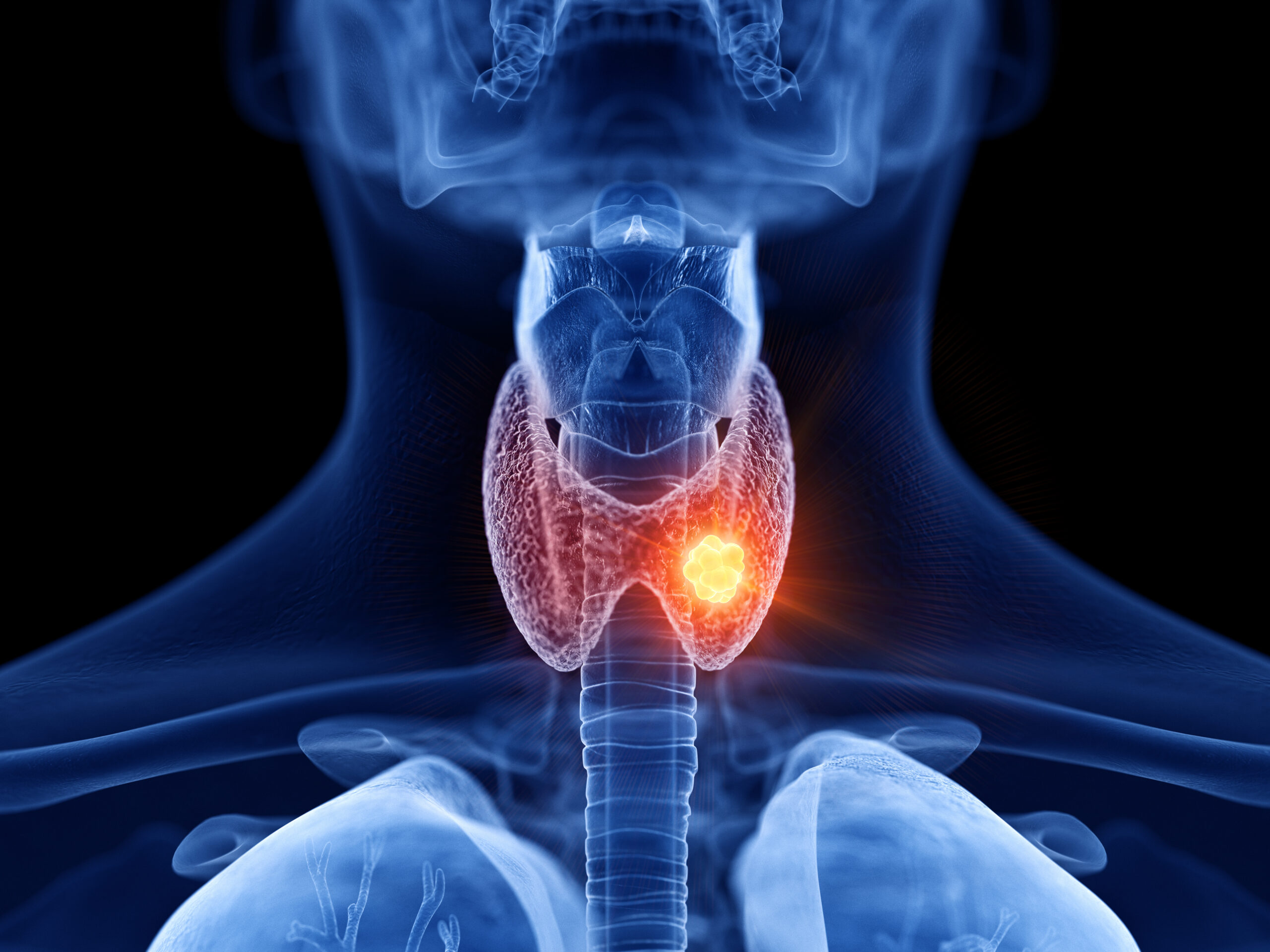 Prof. Francis Worden | Breaking Barriers in Cancer Care: How Lenvatinib Offers Hope for Resistant Thyroid Cancer