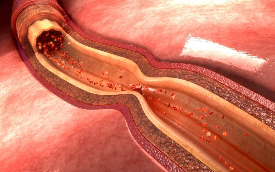 Dr Adrian-Sebastian Zus | When Arteries Rebel: Preventing Radial Artery Spasm