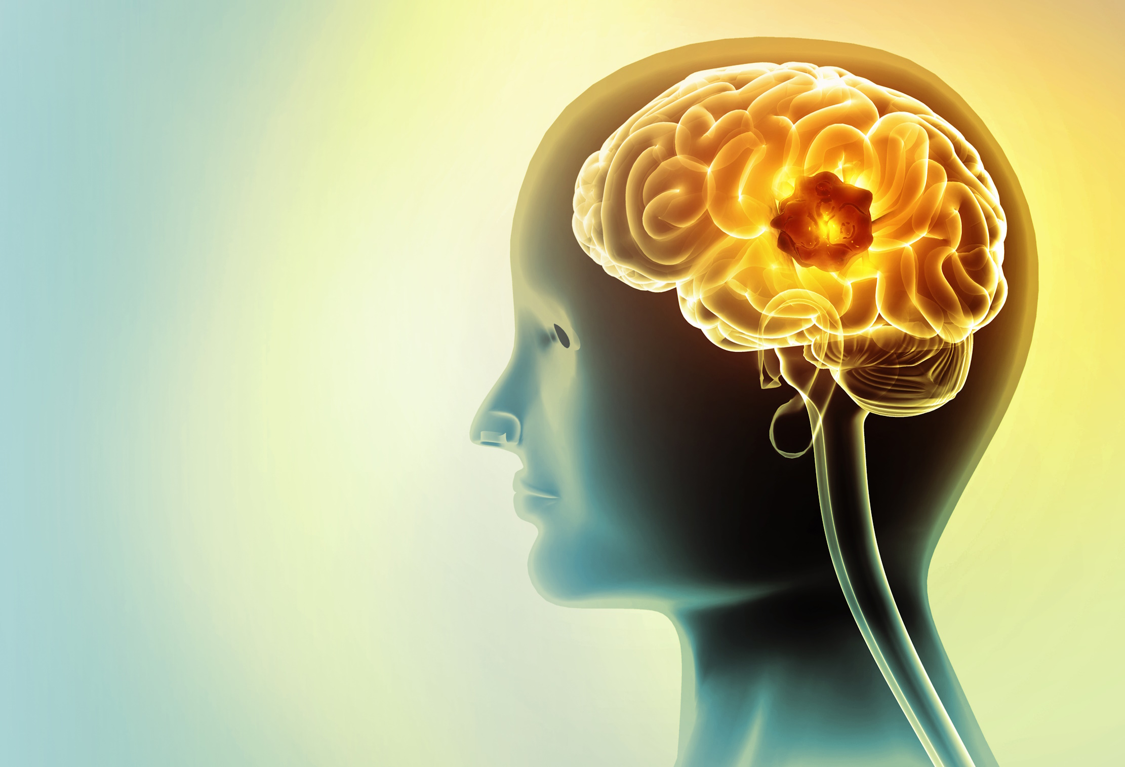 Prof. Jonathan Finlay | A Model for the Rarest Cancers: Choroid Plexus Carcinoma and the Li-Fraumeni Inheritable Cancer Syndrome.