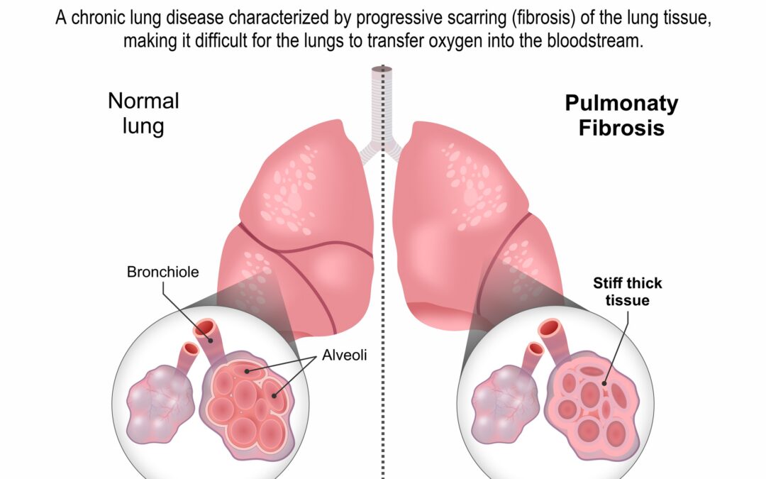 Prof. Yuben Moodley | Signals in the Scars: The Search for New Ways to Predict and Treat Lung Fibrosis